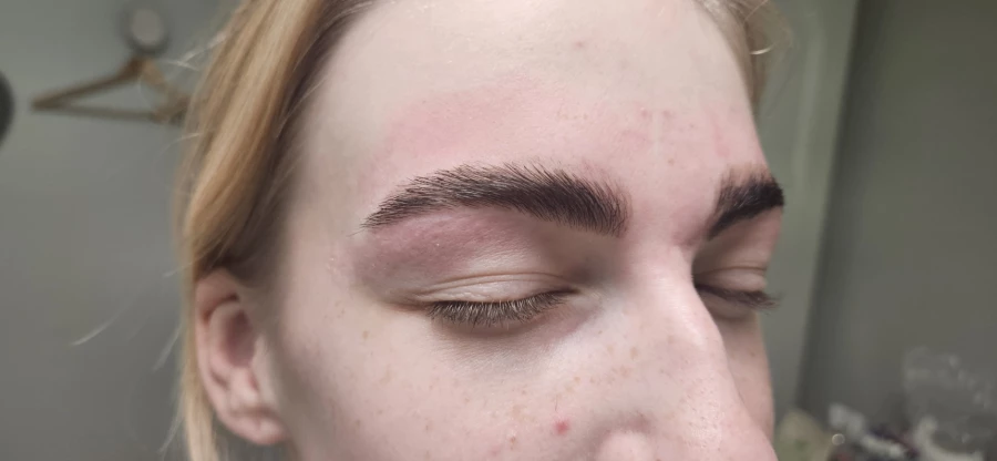 browlift apr&egrave;s